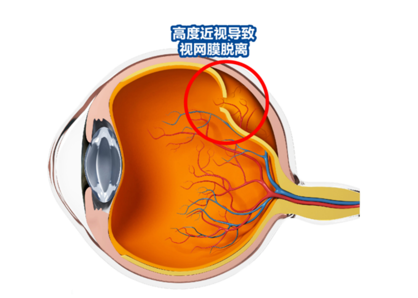 广州男子眼前突然一片黑竟是视网膜脱离