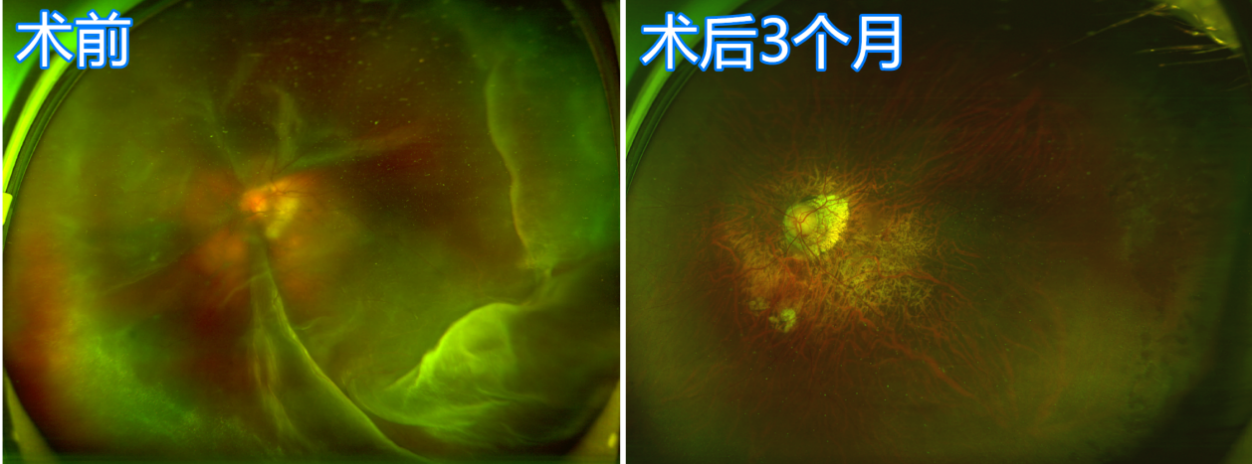 视网膜脱落B超图片