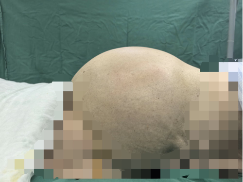 [视频]一名90岁的女人的胃中有一个大卵巢囊肿，