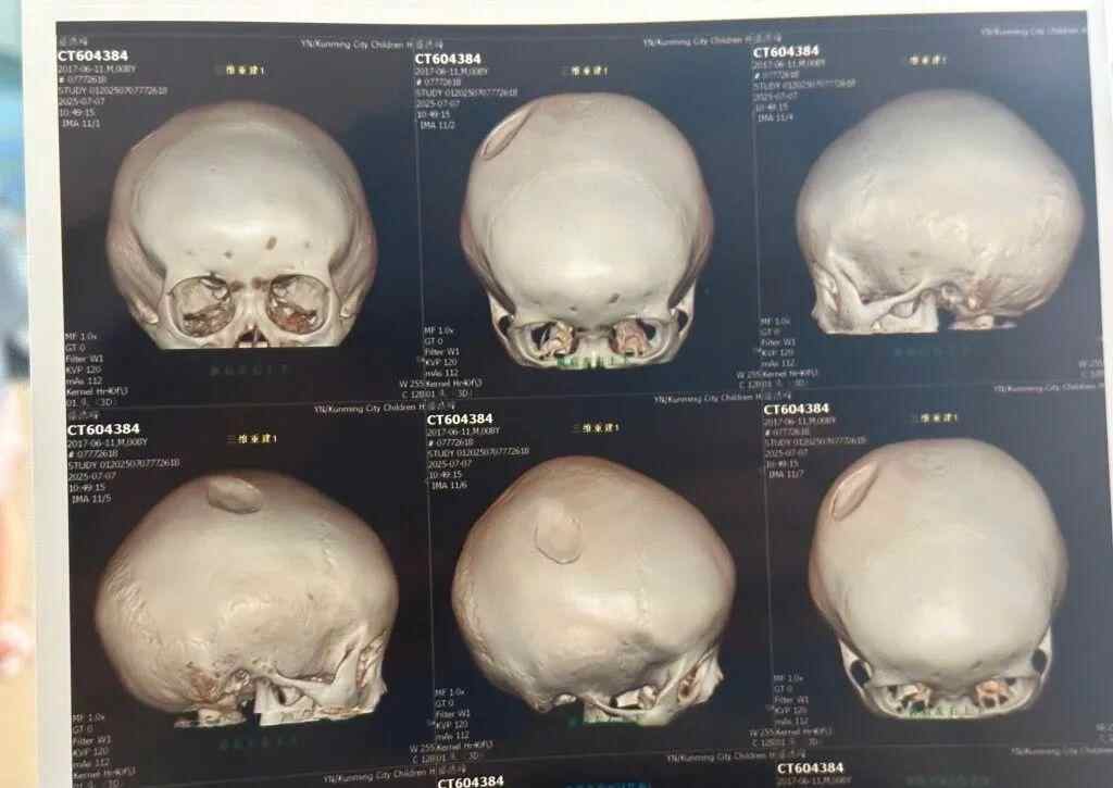 一个8岁的男孩用醉酒的椅子击中了他的头，必须