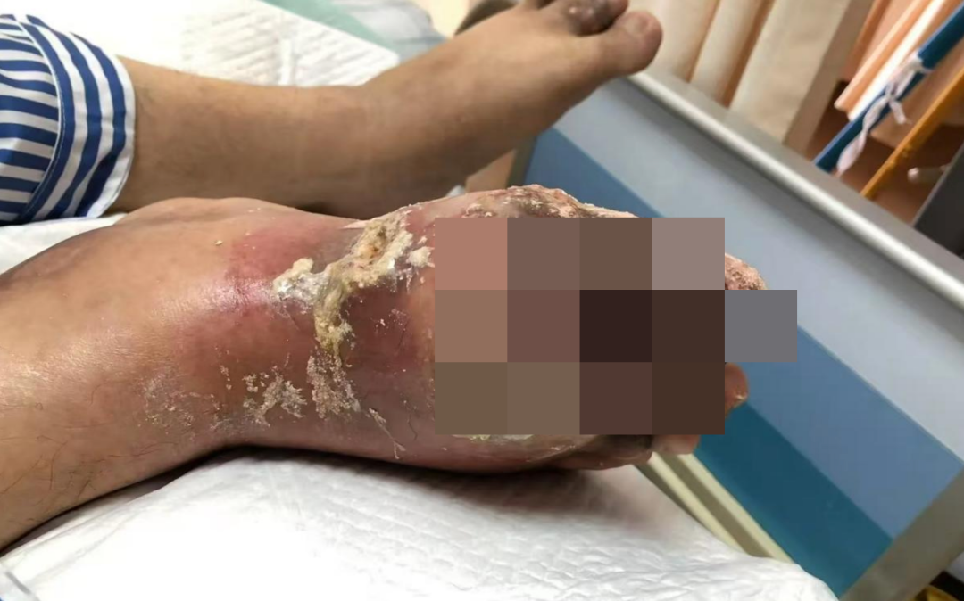 十多年前，他的脚上的“卵石”突然倒塌了，这