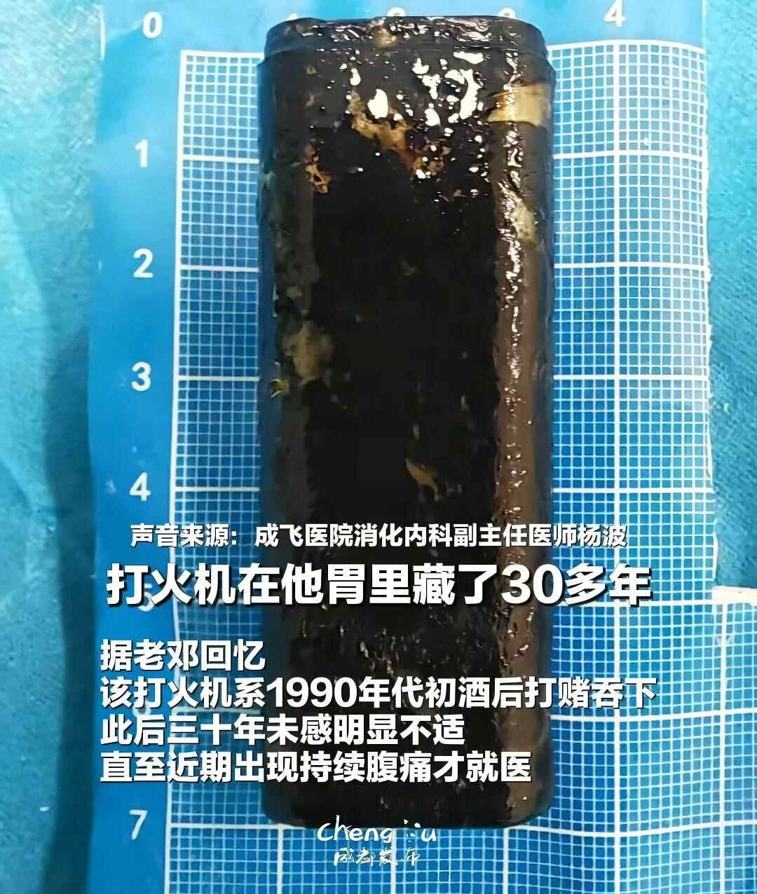 一位老人在醉酒打赌后吞下了打火机。 30年后，他胃痛，去看医生。医生明智地