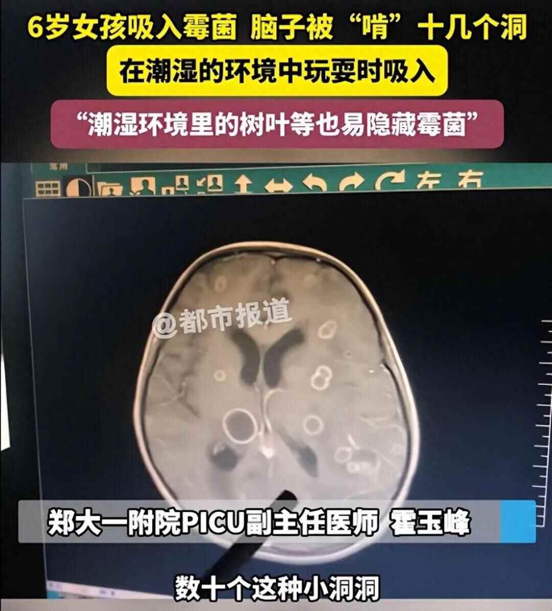  6岁女童发烧17天意识不清，一查脑内竟被“啃”出十几个洞！医生：元凶很常见，家里这些地方要注意→